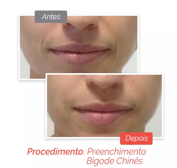 Preenchimento Facial