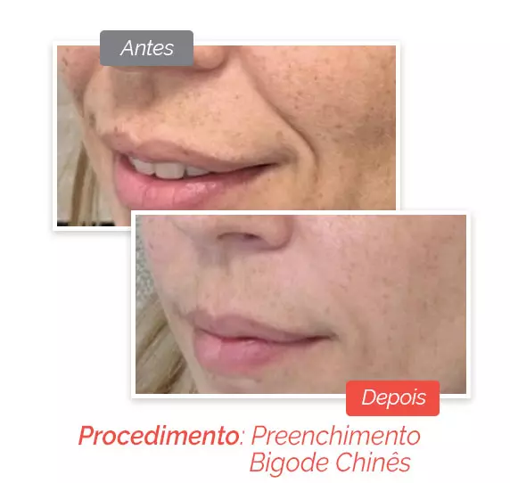 Preenchimento Facial