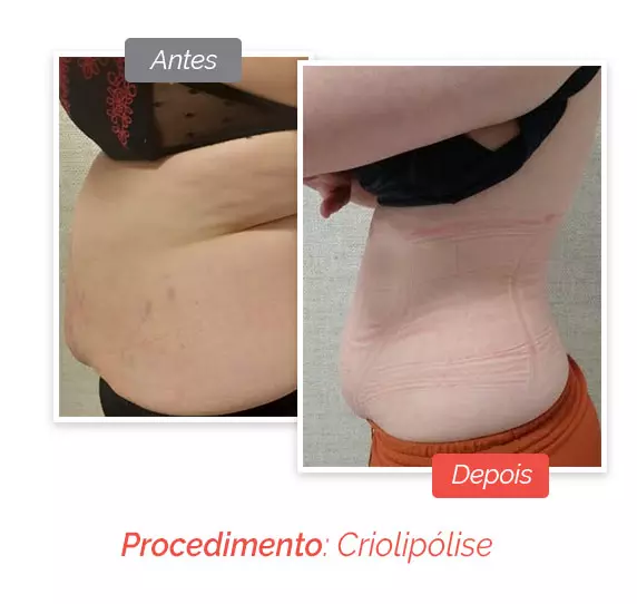 Criolipólise